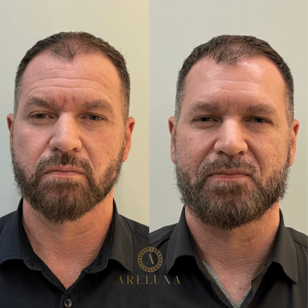 Linhas da testa — caso real Instituto Areluna